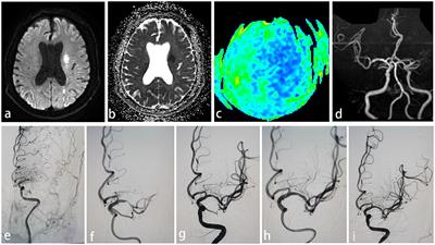 Short-term efficacy of stenting as a rescue therapy for acute atherosclerotic occlusion in anterior cerebral circulation